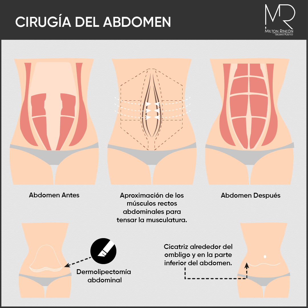 Evolución de abdominoplastia